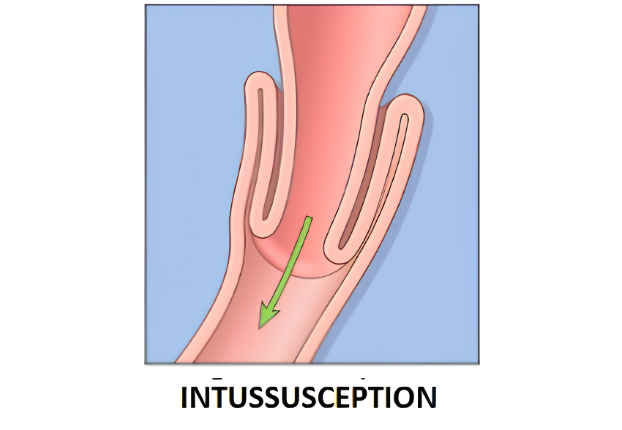 Strangulated hernia progression diagram